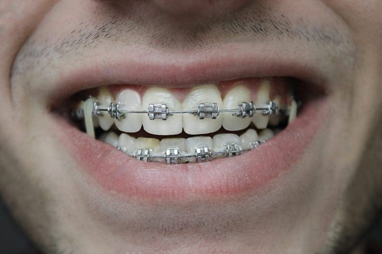 Brace Yourself 7 Fun Facts About Orthodontics Smile Ranch